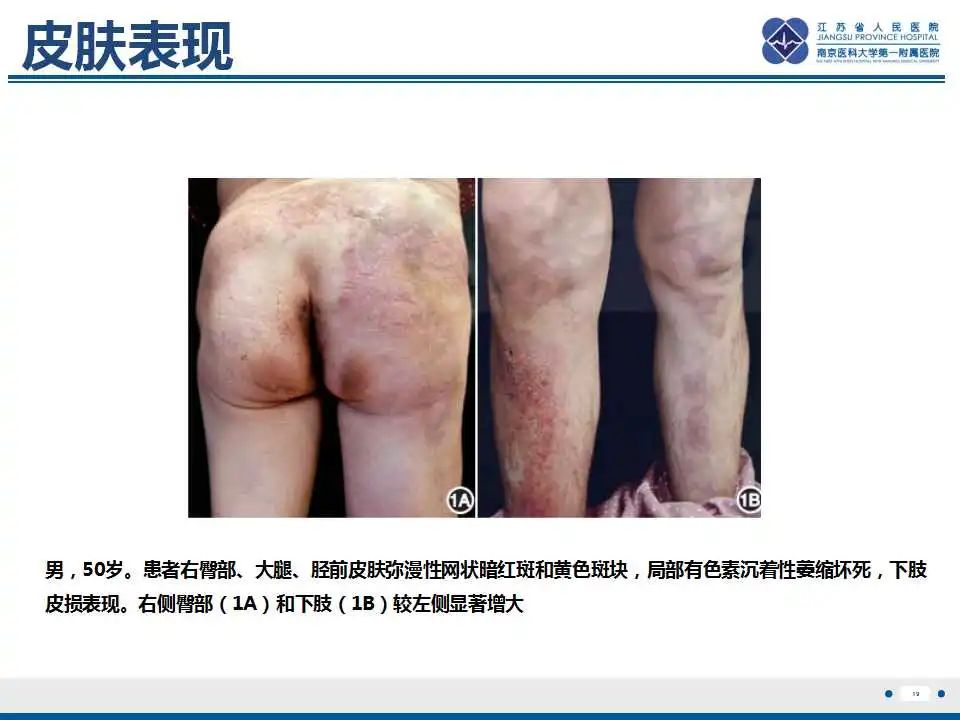 影像PPT - 【PPT】肿瘤样钙质沉着症-20