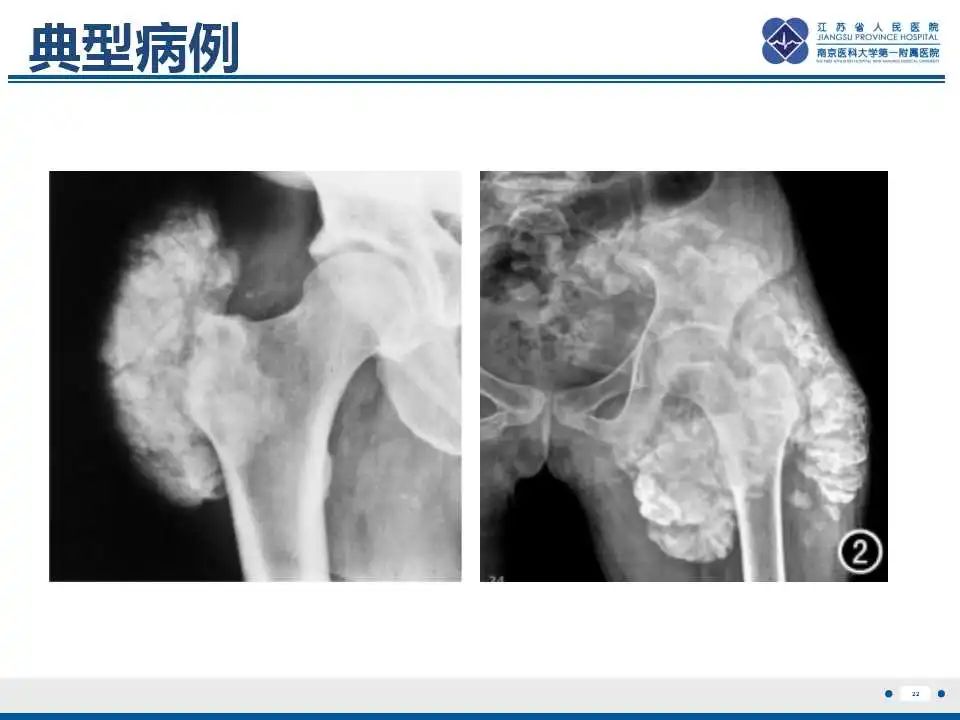 影像PPT - 【PPT】肿瘤样钙质沉着症-23