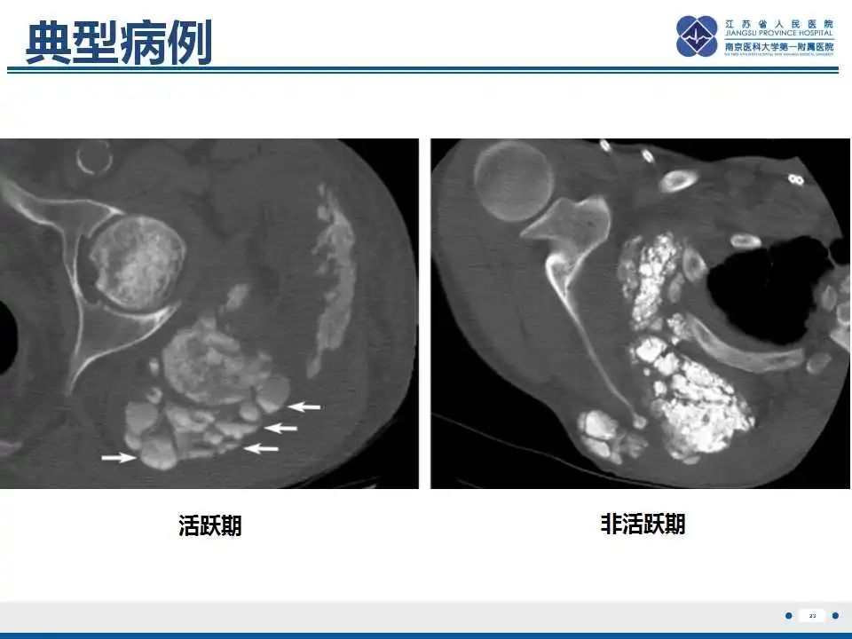 影像PPT - 【PPT】肿瘤样钙质沉着症-24