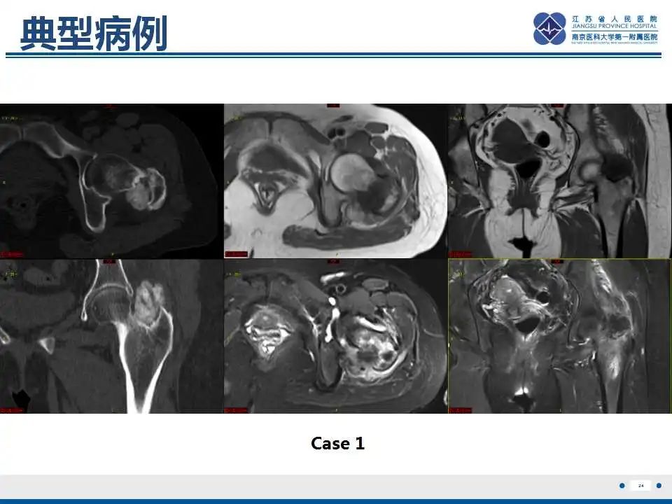 影像PPT - 【PPT】肿瘤样钙质沉着症-25