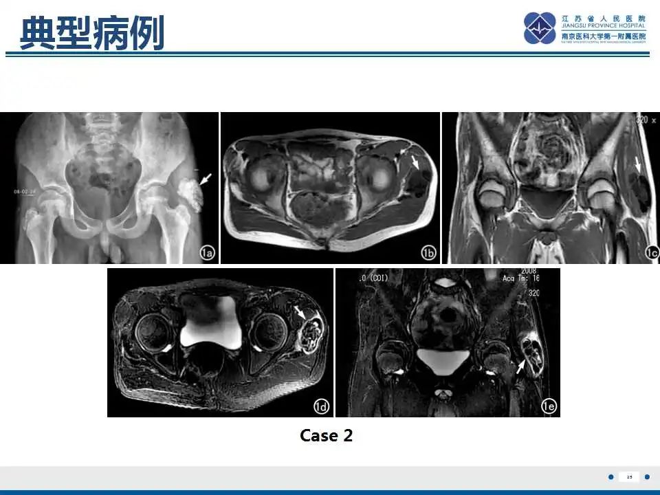 影像PPT - 【PPT】肿瘤样钙质沉着症-26