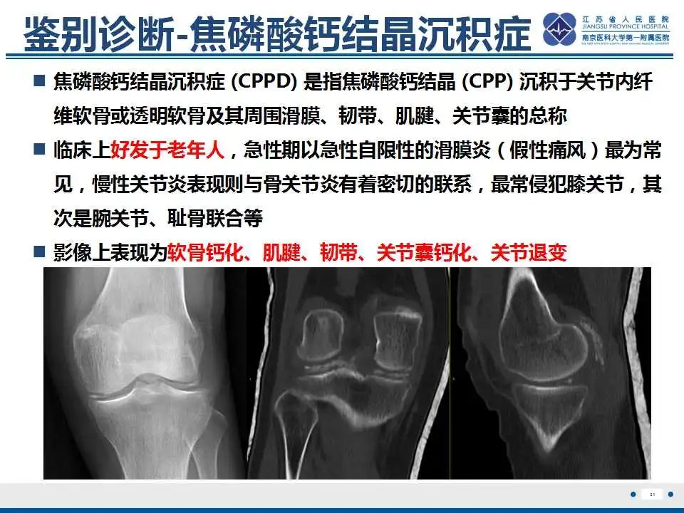 影像PPT - 【PPT】肿瘤样钙质沉着症-32