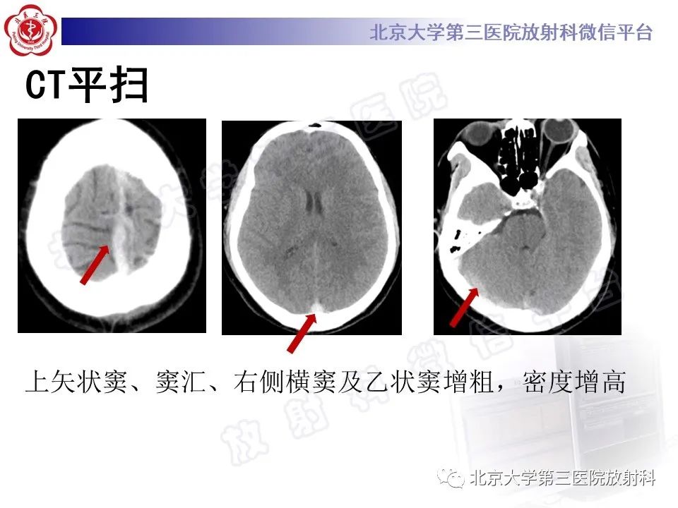 影像PPT - 【PPT】颅内静脉窦血栓-5