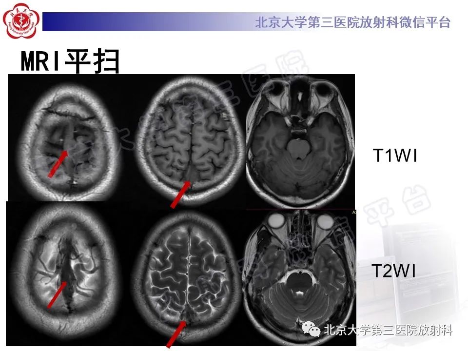 影像PPT - 【PPT】颅内静脉窦血栓-6