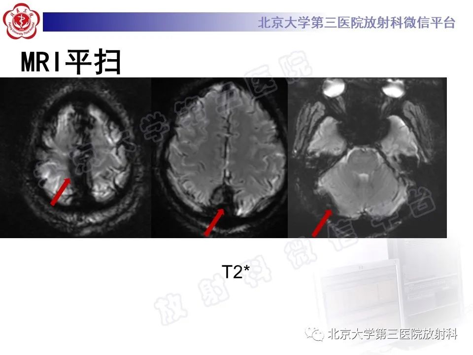 影像PPT - 【PPT】颅内静脉窦血栓-7