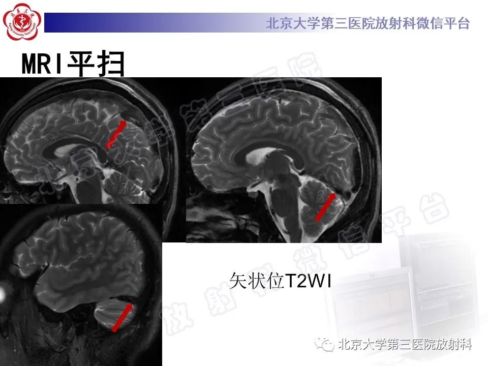 影像PPT - 【PPT】颅内静脉窦血栓-8