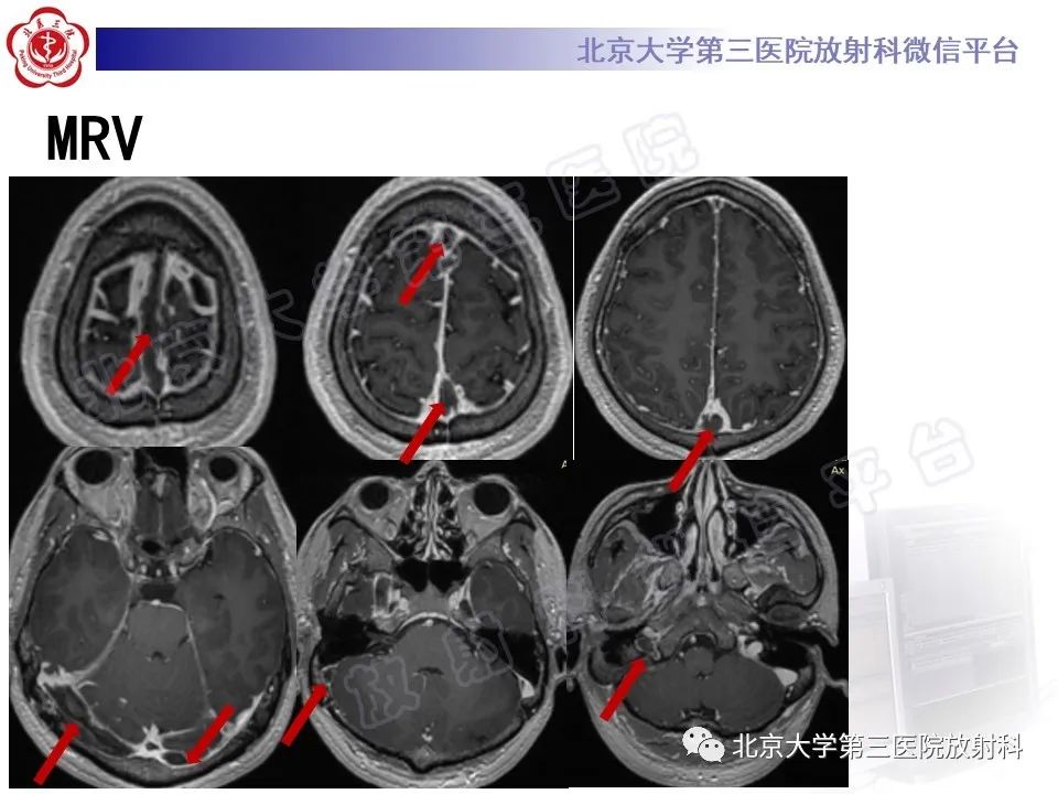 影像PPT - 【PPT】颅内静脉窦血栓-9