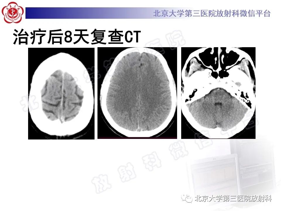 影像PPT - 【PPT】颅内静脉窦血栓-11