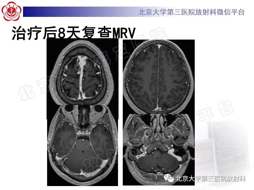 影像PPT - 【PPT】颅内静脉窦血栓-12