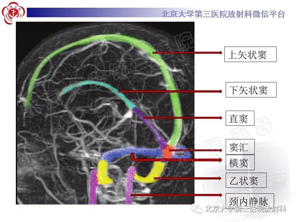 影像PPT - 【PPT】颅内静脉窦血栓-14