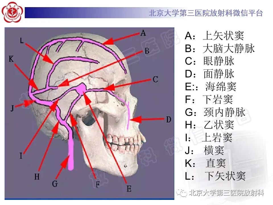 影像PPT - 【PPT】颅内静脉窦血栓-15