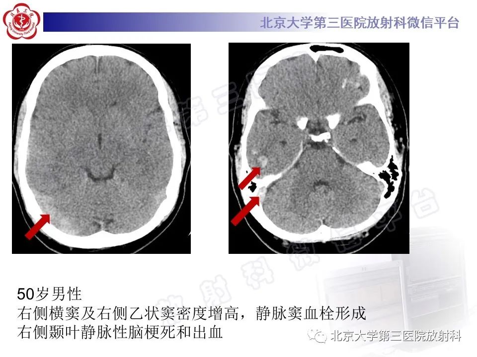 影像PPT - 【PPT】颅内静脉窦血栓-26