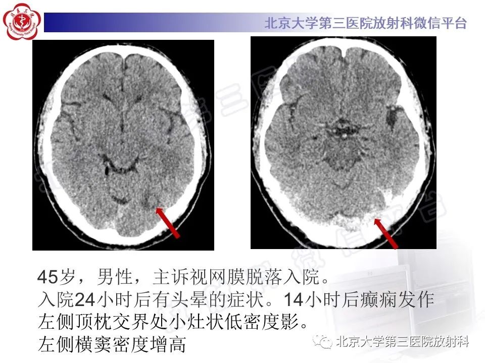 影像PPT - 【PPT】颅内静脉窦血栓-29