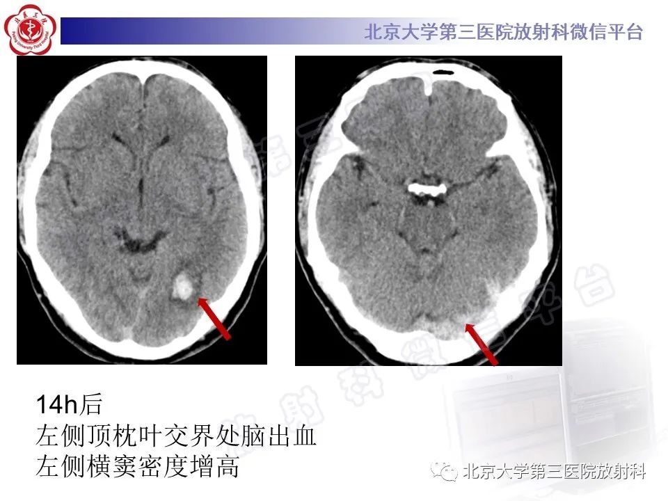 影像PPT - 【PPT】颅内静脉窦血栓-30