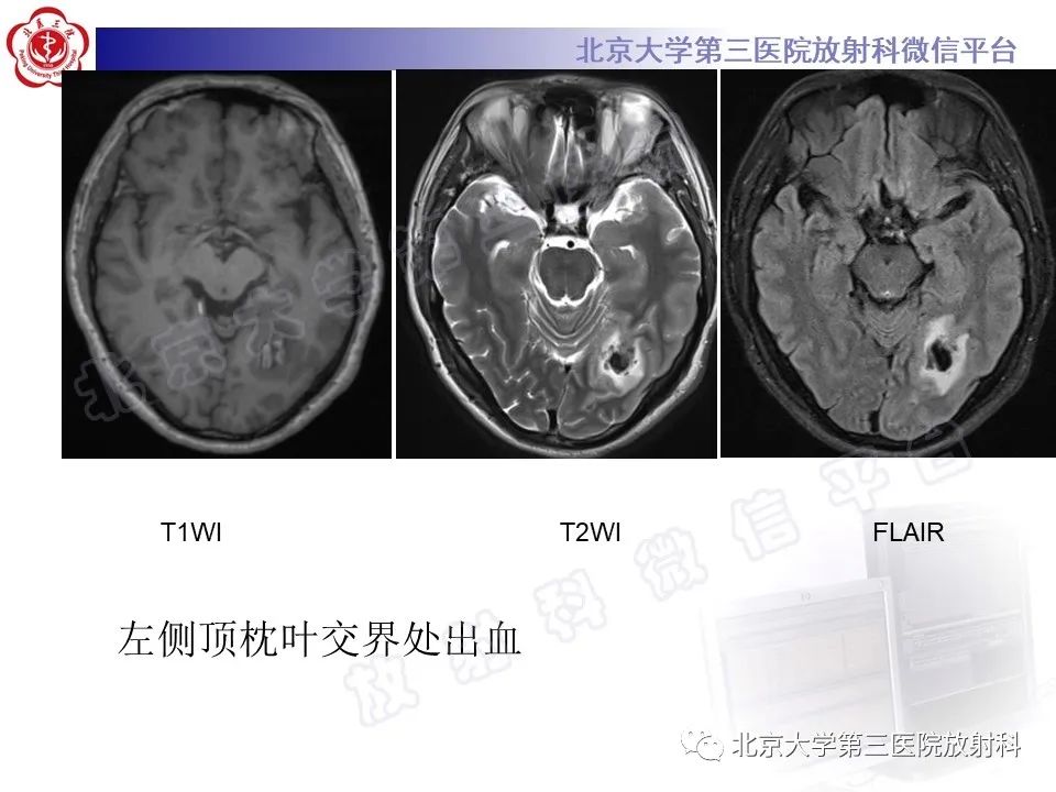 影像PPT - 【PPT】颅内静脉窦血栓-31