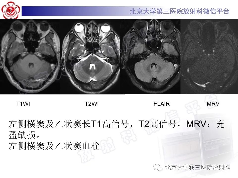 影像PPT - 【PPT】颅内静脉窦血栓-32