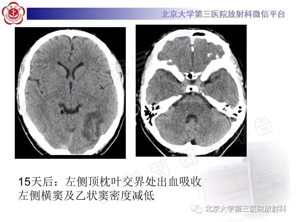 影像PPT - 【PPT】颅内静脉窦血栓-33