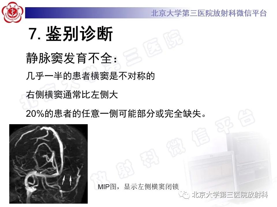 影像PPT - 【PPT】颅内静脉窦血栓-35