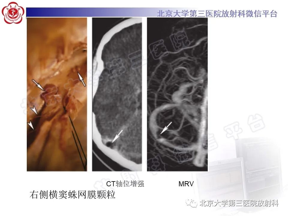 影像PPT - 【PPT】颅内静脉窦血栓-37