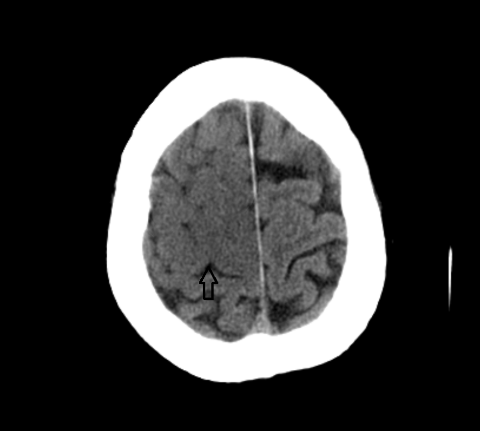 影像PPT - 超急性期大面积脑梗死 CT 平扫表现-5 影像PPT - 超急性期大面积脑梗死 CT 平扫表现-5