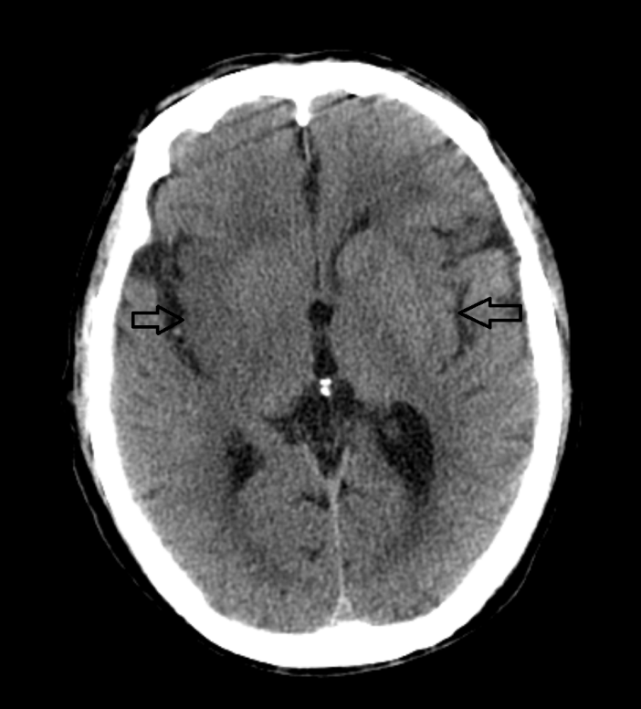 影像PPT - 超急性期大面积脑梗死 CT 平扫表现-3 影像PPT - 超急性期大面积脑梗死 CT 平扫表现-3