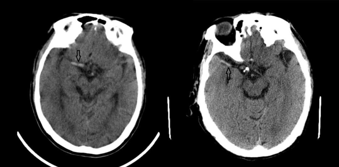 影像PPT - 超急性期大面积脑梗死 CT 平扫表现-2 影像PPT - 超急性期大面积脑梗死 CT 平扫表现-2