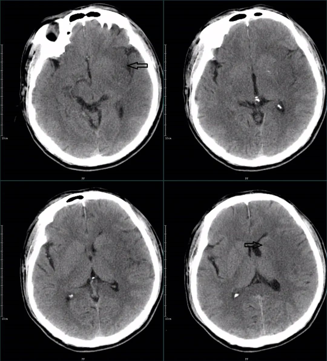 影像PPT - 超急性期大面积脑梗死 CT 平扫表现-6 影像PPT - 超急性期大面积脑梗死 CT 平扫表现-6