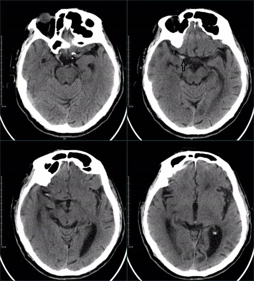 影像PPT - 超急性期大面积脑梗死 CT 平扫表现-7 影像PPT - 超急性期大面积脑梗死 CT 平扫表现-7