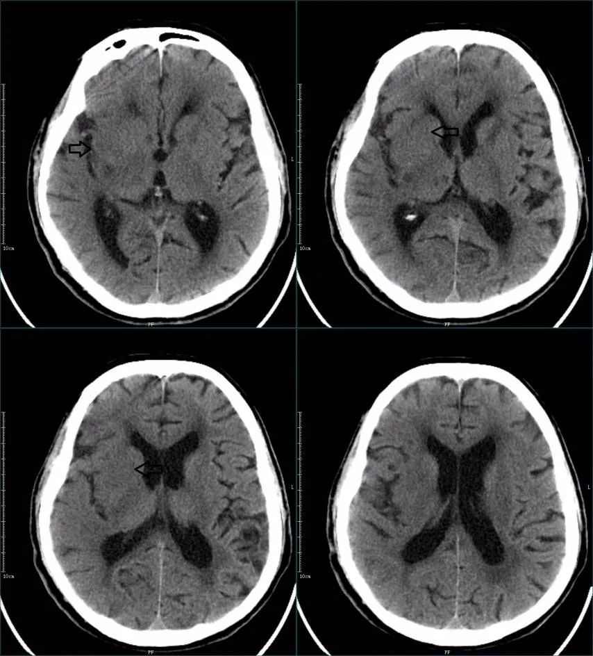 影像PPT - 超急性期大面积脑梗死 CT 平扫表现-8 影像PPT - 超急性期大面积脑梗死 CT 平扫表现-8