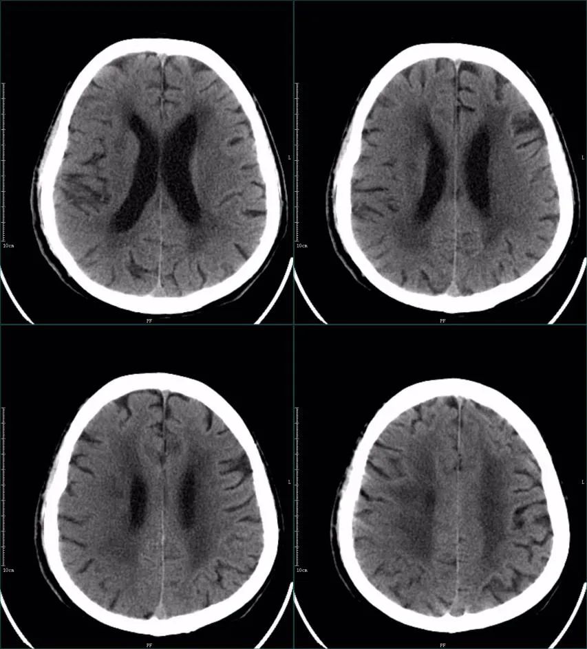 影像PPT - 超急性期大面积脑梗死 CT 平扫表现-9 影像PPT - 超急性期大面积脑梗死 CT 平扫表现-9