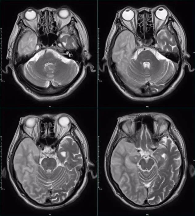 影像PPT - 超急性期大面积脑梗死 CT 平扫表现-10 影像PPT - 超急性期大面积脑梗死 CT 平扫表现-10
