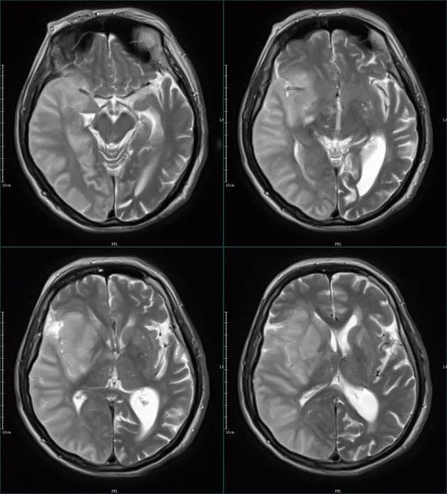 影像PPT - 超急性期大面积脑梗死 CT 平扫表现-11 影像PPT - 超急性期大面积脑梗死 CT 平扫表现-11