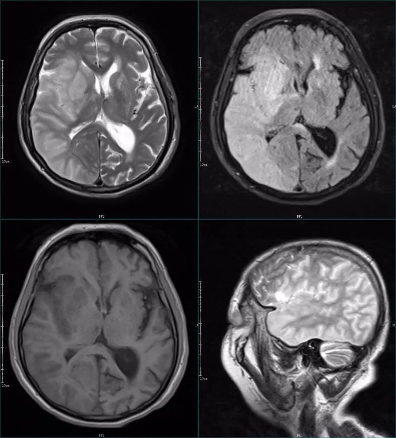 影像PPT - 超急性期大面积脑梗死 CT 平扫表现-12 影像PPT - 超急性期大面积脑梗死 CT 平扫表现-12