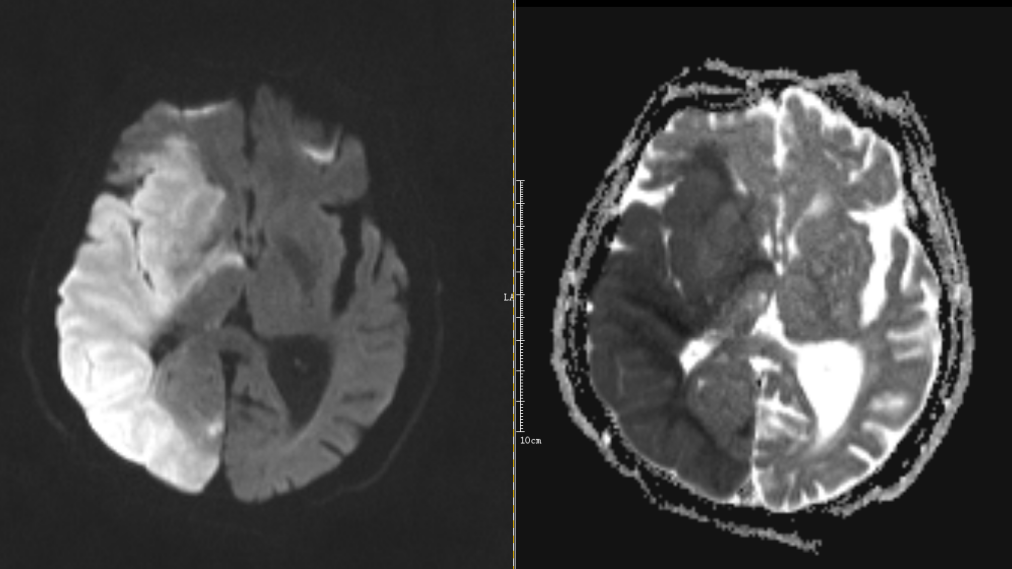 影像PPT - 超急性期大面积脑梗死 CT 平扫表现-13 影像PPT - 超急性期大面积脑梗死 CT 平扫表现-13