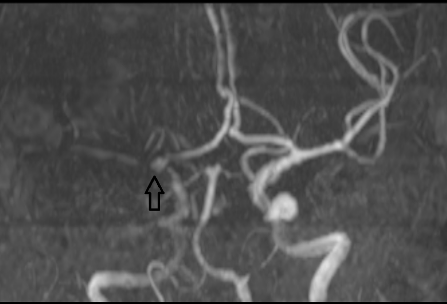 影像PPT - 超急性期大面积脑梗死 CT 平扫表现-14 影像PPT - 超急性期大面积脑梗死 CT 平扫表现-14