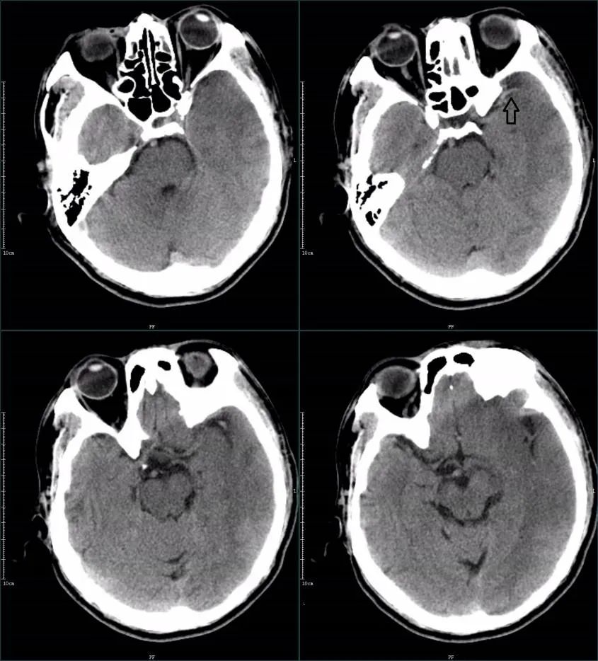 影像PPT - 超急性期大面积脑梗死 CT 平扫表现-15 影像PPT - 超急性期大面积脑梗死 CT 平扫表现-15