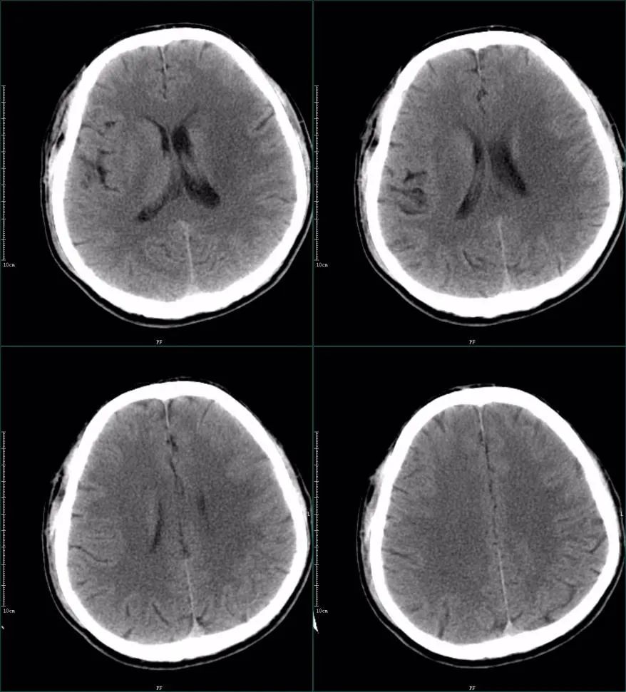 影像PPT - 超急性期大面积脑梗死 CT 平扫表现-17 影像PPT - 超急性期大面积脑梗死 CT 平扫表现-17