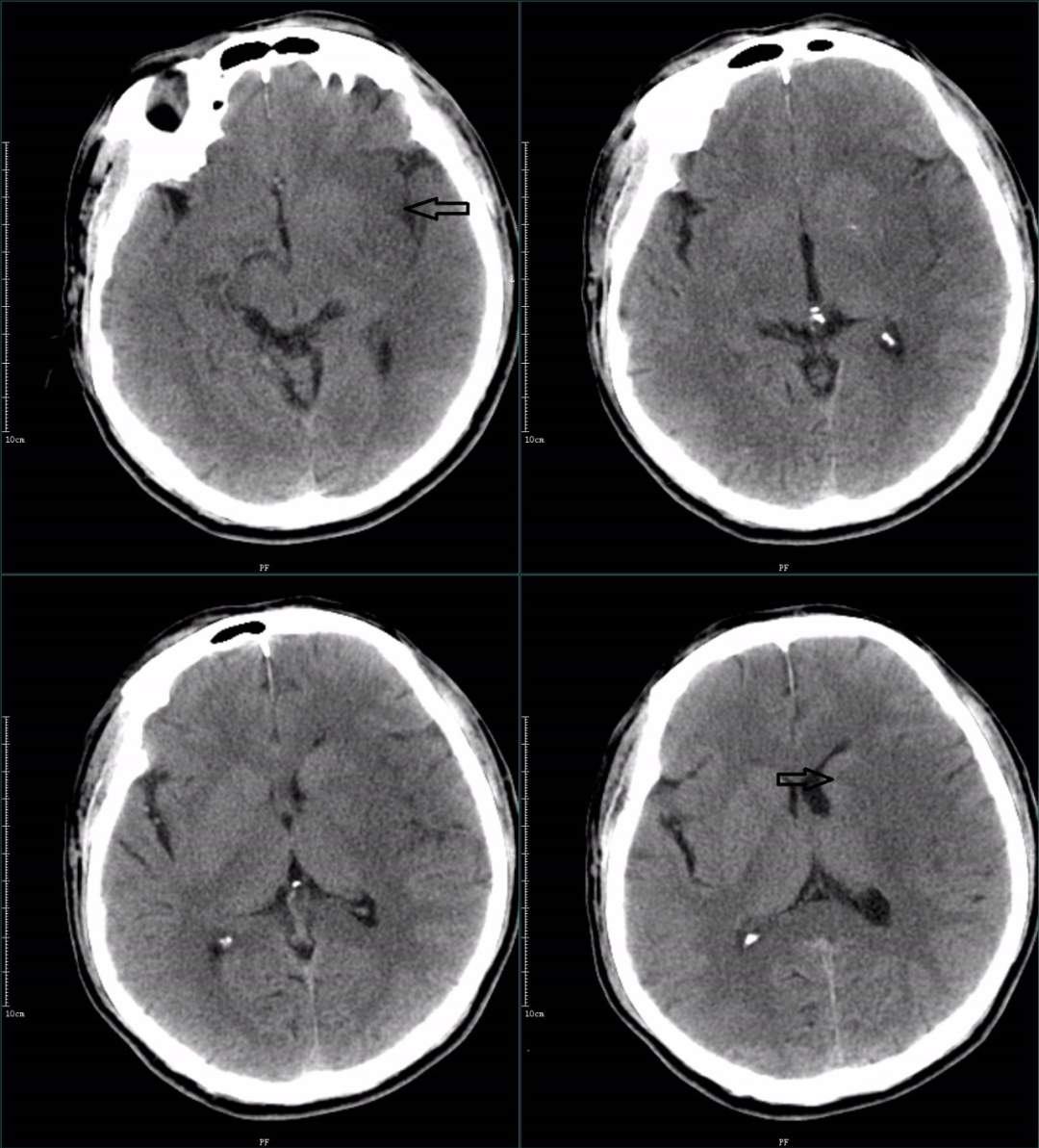 影像PPT - 超急性期大面积脑梗死 CT 平扫表现-16 影像PPT - 超急性期大面积脑梗死 CT 平扫表现-16