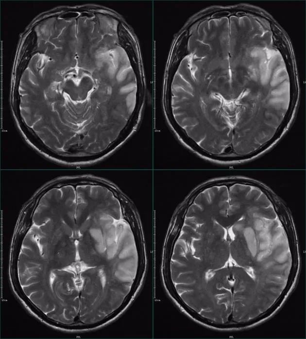 影像PPT - 超急性期大面积脑梗死 CT 平扫表现-18 影像PPT - 超急性期大面积脑梗死 CT 平扫表现-18