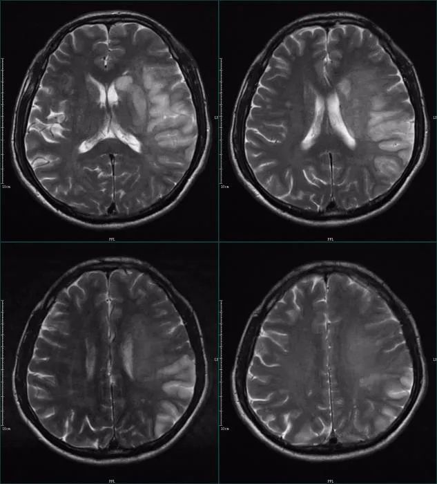 影像PPT - 超急性期大面积脑梗死 CT 平扫表现-19 影像PPT - 超急性期大面积脑梗死 CT 平扫表现-19