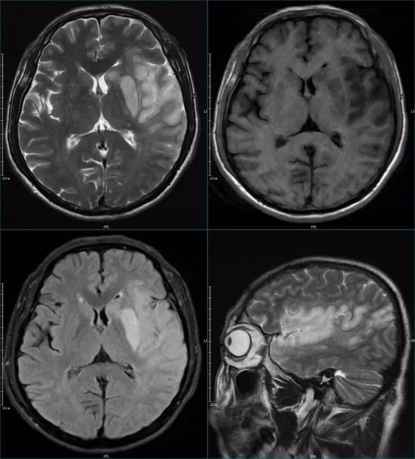 影像PPT - 超急性期大面积脑梗死 CT 平扫表现-20 影像PPT - 超急性期大面积脑梗死 CT 平扫表现-20