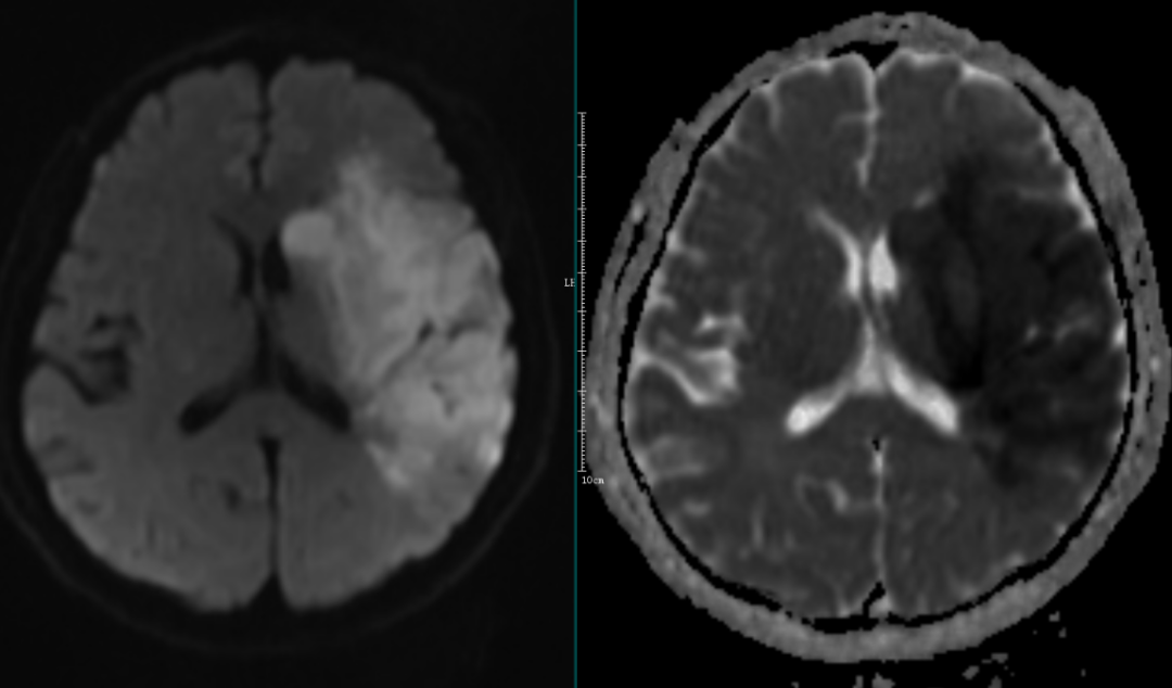 影像PPT - 超急性期大面积脑梗死 CT 平扫表现-21 影像PPT - 超急性期大面积脑梗死 CT 平扫表现-21