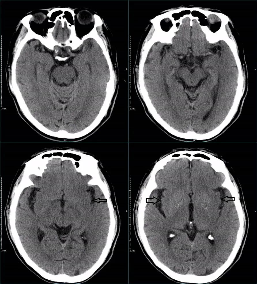 影像PPT - 超急性期大面积脑梗死 CT 平扫表现-23 影像PPT - 超急性期大面积脑梗死 CT 平扫表现-23