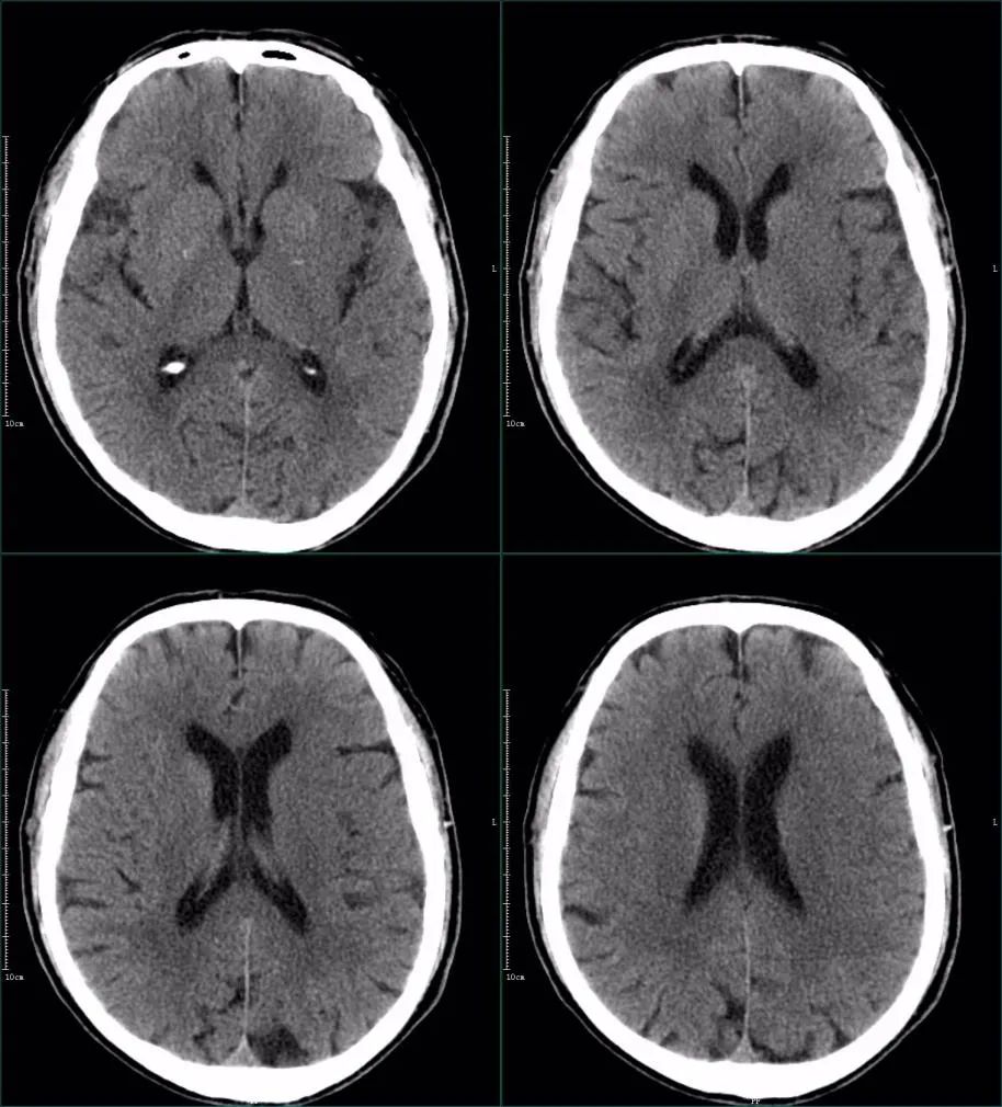 影像PPT - 超急性期大面积脑梗死 CT 平扫表现-24 影像PPT - 超急性期大面积脑梗死 CT 平扫表现-24