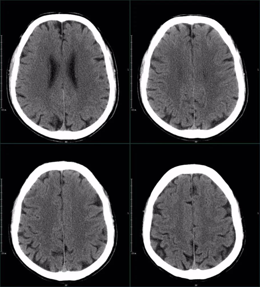 影像PPT - 超急性期大面积脑梗死 CT 平扫表现-25 影像PPT - 超急性期大面积脑梗死 CT 平扫表现-25