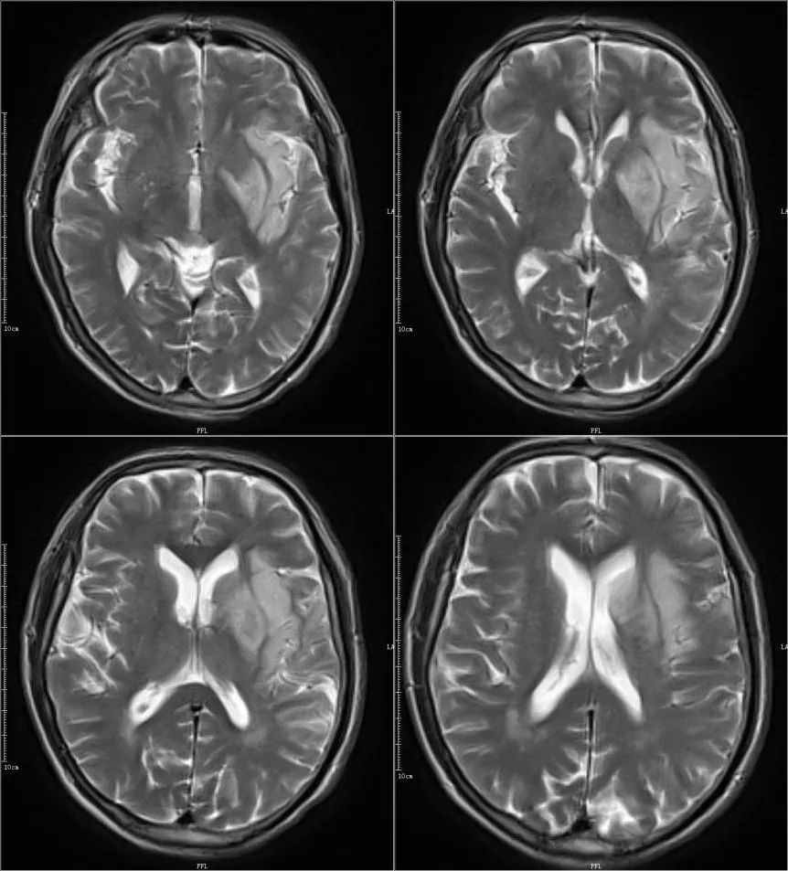 影像PPT - 超急性期大面积脑梗死 CT 平扫表现-26 影像PPT - 超急性期大面积脑梗死 CT 平扫表现-26