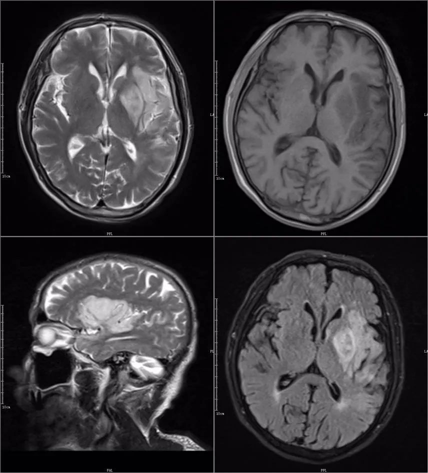 影像PPT - 超急性期大面积脑梗死 CT 平扫表现-27 影像PPT - 超急性期大面积脑梗死 CT 平扫表现-27