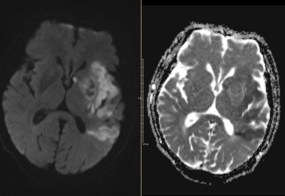 影像PPT - 超急性期大面积脑梗死 CT 平扫表现-28 影像PPT - 超急性期大面积脑梗死 CT 平扫表现-28