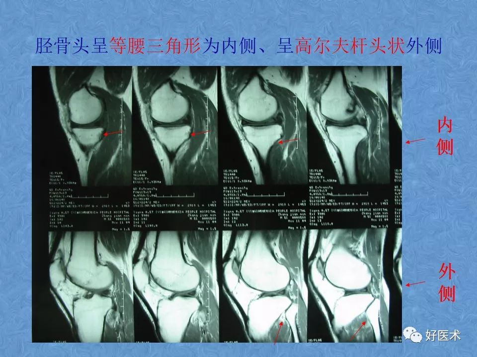 影像PPT - 【PPT】膝关节MRI正常解剖-5