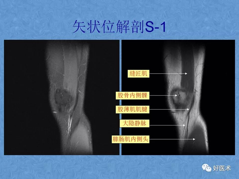 影像PPT - 【PPT】膝关节MRI正常解剖-6